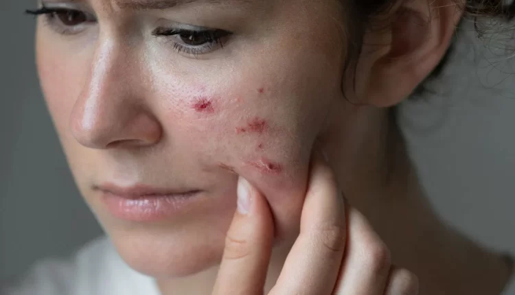 are you troubled by oily skin